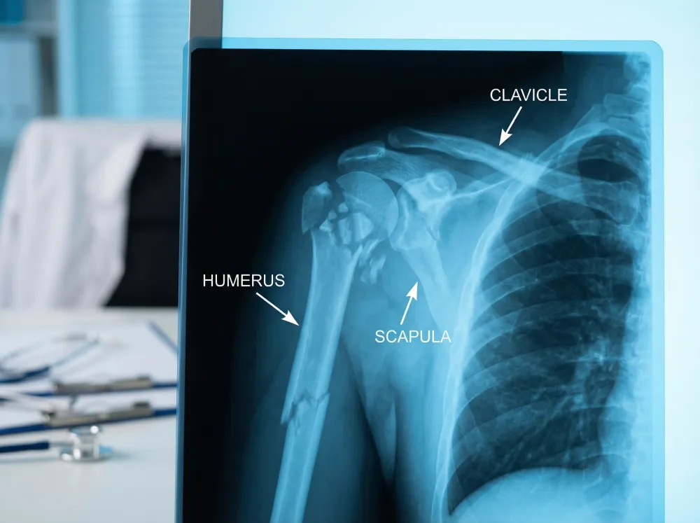 Medical X-ray of a shattered shoulder joint displayed on a clinical light box